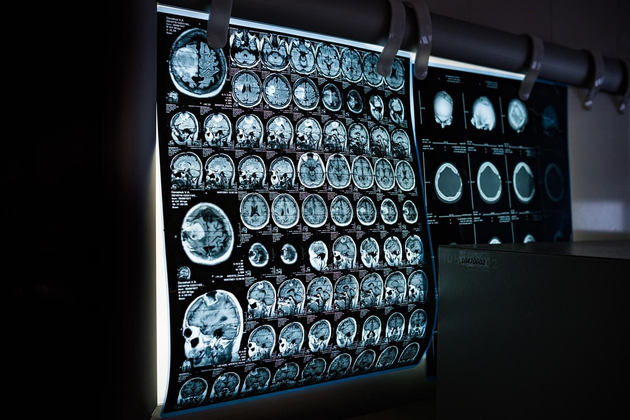 NV-Reason-CT: 3D CT-ket natívan feldolgozó láncolt gondolkodású VLM radiológiai támogatáshoz